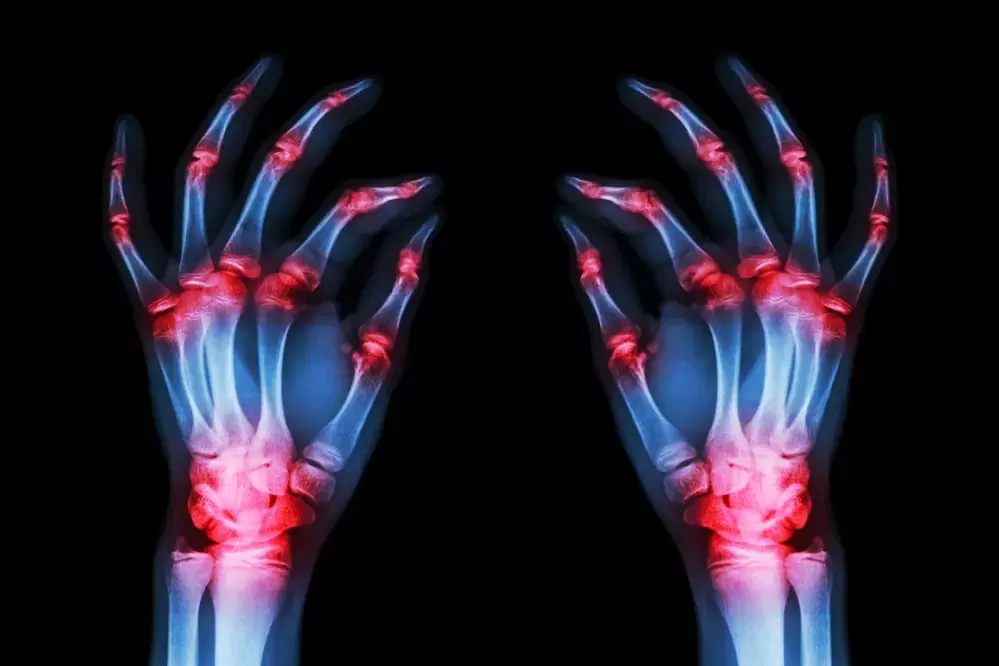 artroza stawów palców
