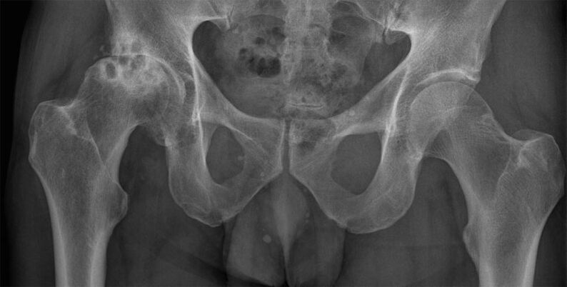 Artroza stawu biodrowego III stopnia na zdjęciu rentgenowskim