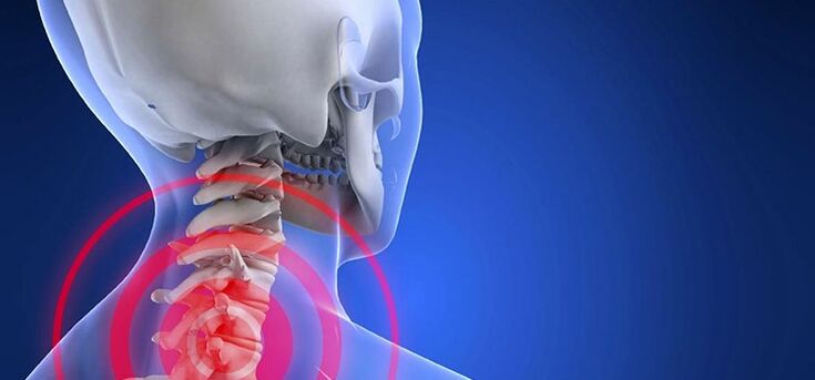 Osteochondroza obszaru szyjki macicy