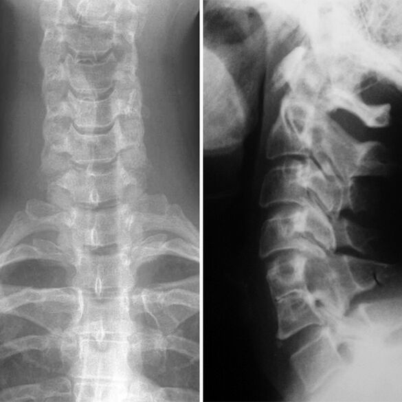 X -Ray kręgosłupa szyjnego