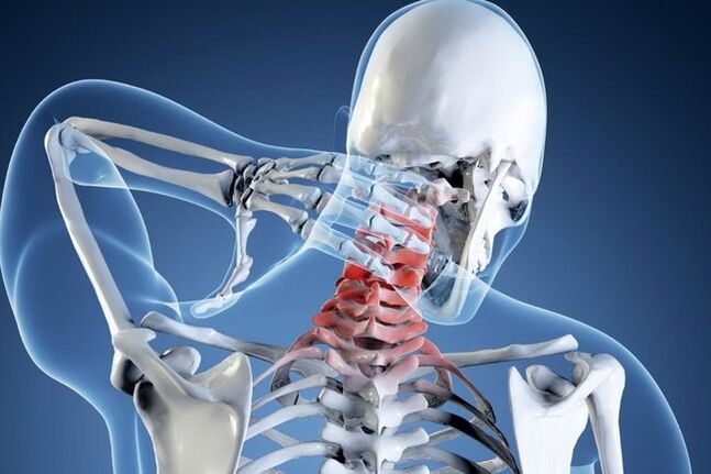 Osteochondroza obszaru szyjki macicy