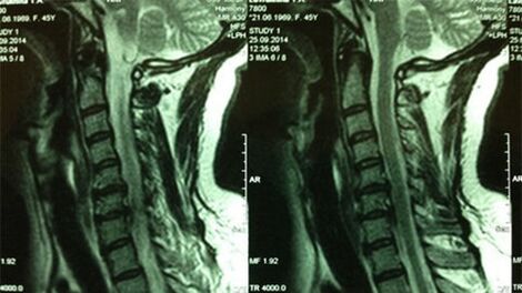 MRI z działu szyjki macicy