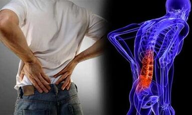 Przyczyny rozwoju osteochondrozy lędźwiowej