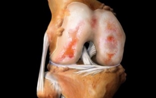co to jest artroza kolana