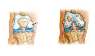 zmiany patologiczne w artrozie kolana