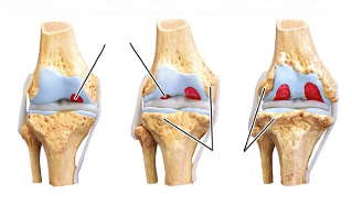etapy artrozy kolana