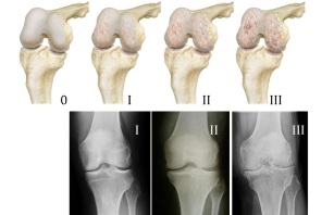 metody diagnozowania artrozy kolana