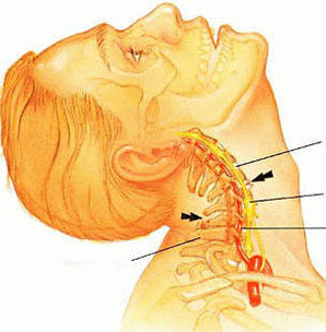 Osteochondroza kręgosłupa szyjnego