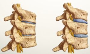 jak wygląda osteochondroza
