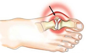Zapalenie stawu między kciukiem a stopą w zapaleniu stawów