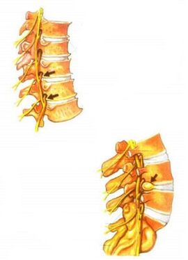 ilustracja osteochondrozy kręgosłupa
