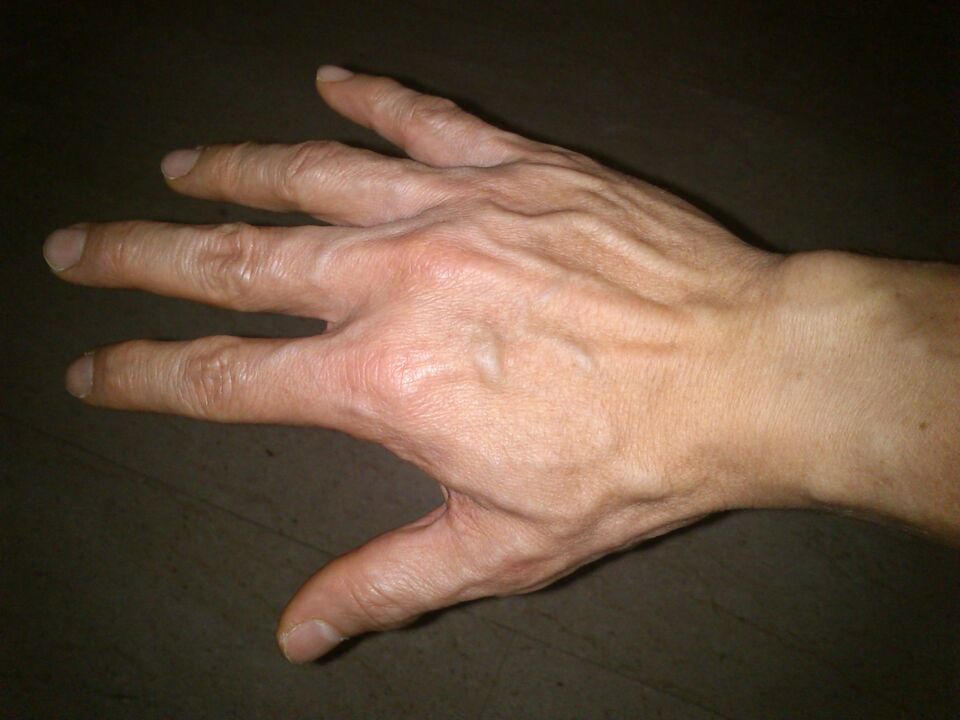 deformacja kości i bóle stawów palców