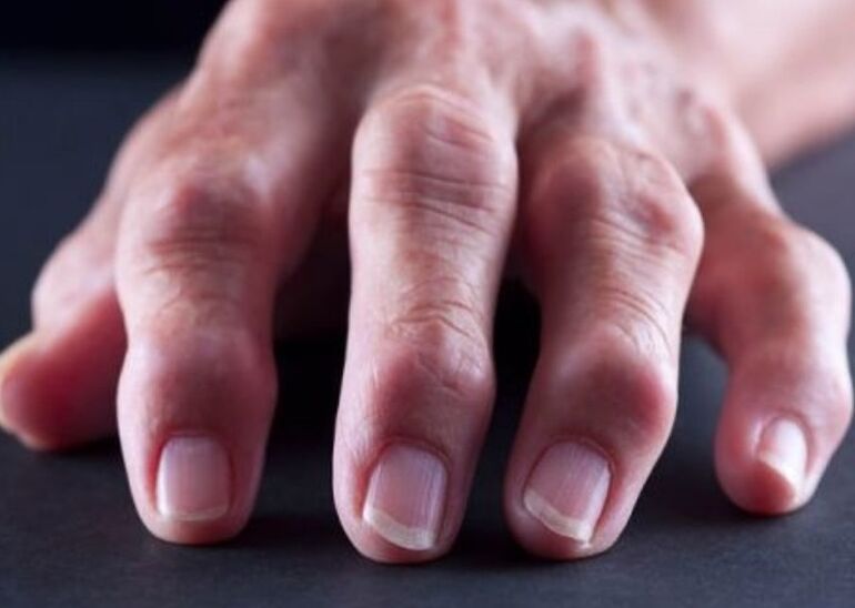 reumatoidalne zapalenie stawów jako przyczyna bólu stawów palców
